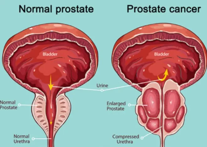 Prostate Cancer Treatment Paradox