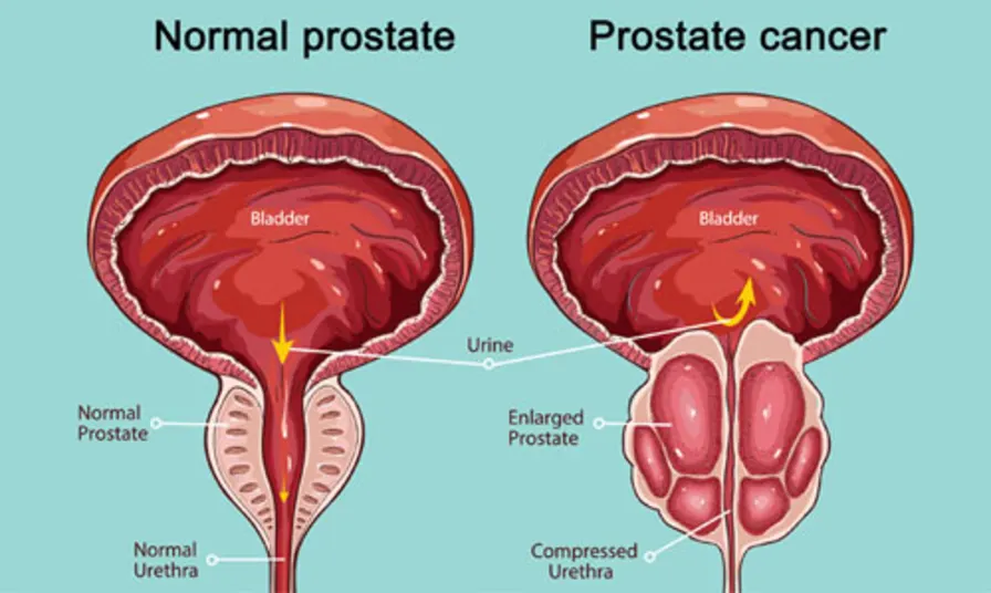 Prostate Cancer Treatment Paradox